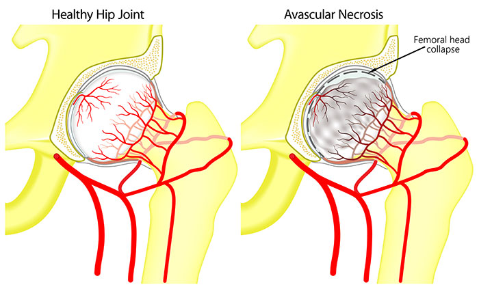 Healthy Hip Joint vs Avascular necrosis